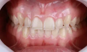 Depois - Mordida Cruzada